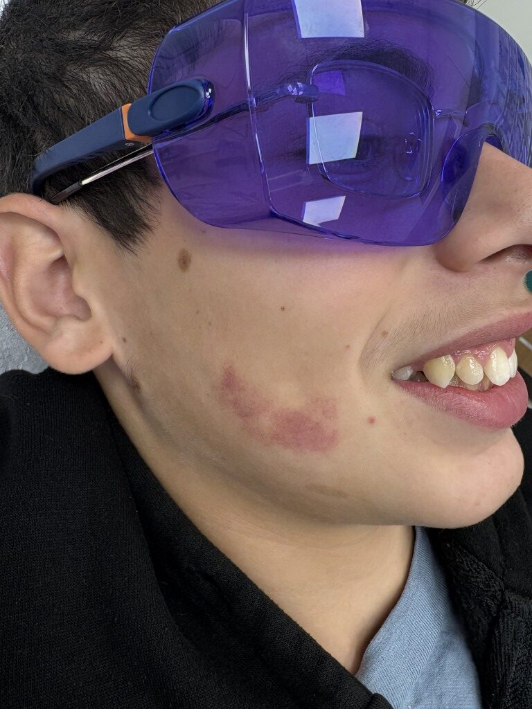 ילד בטיפול ליזר