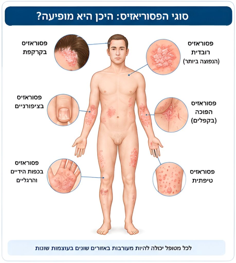 איור המחשה - היכן מופיעה פסוריאזיס